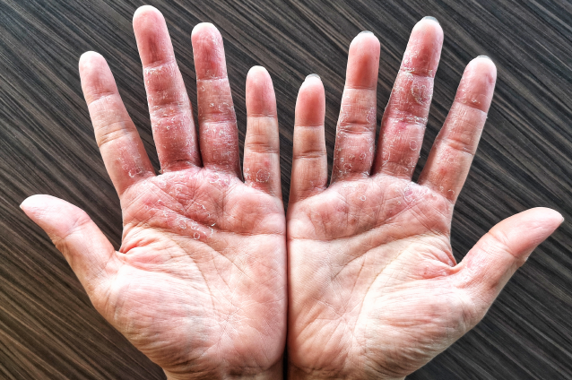 About Severe Chronic Hand Eczema Stiefel